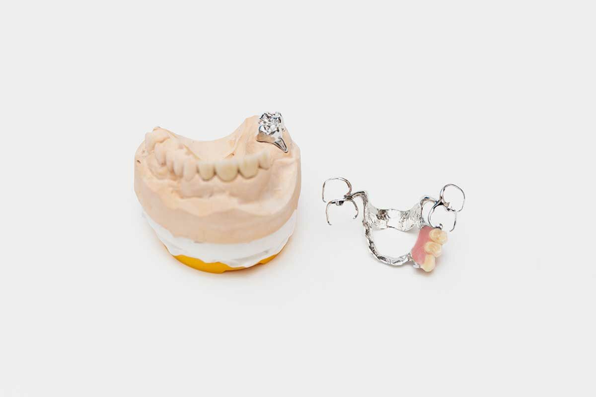 Kombinierter Zahnersatz