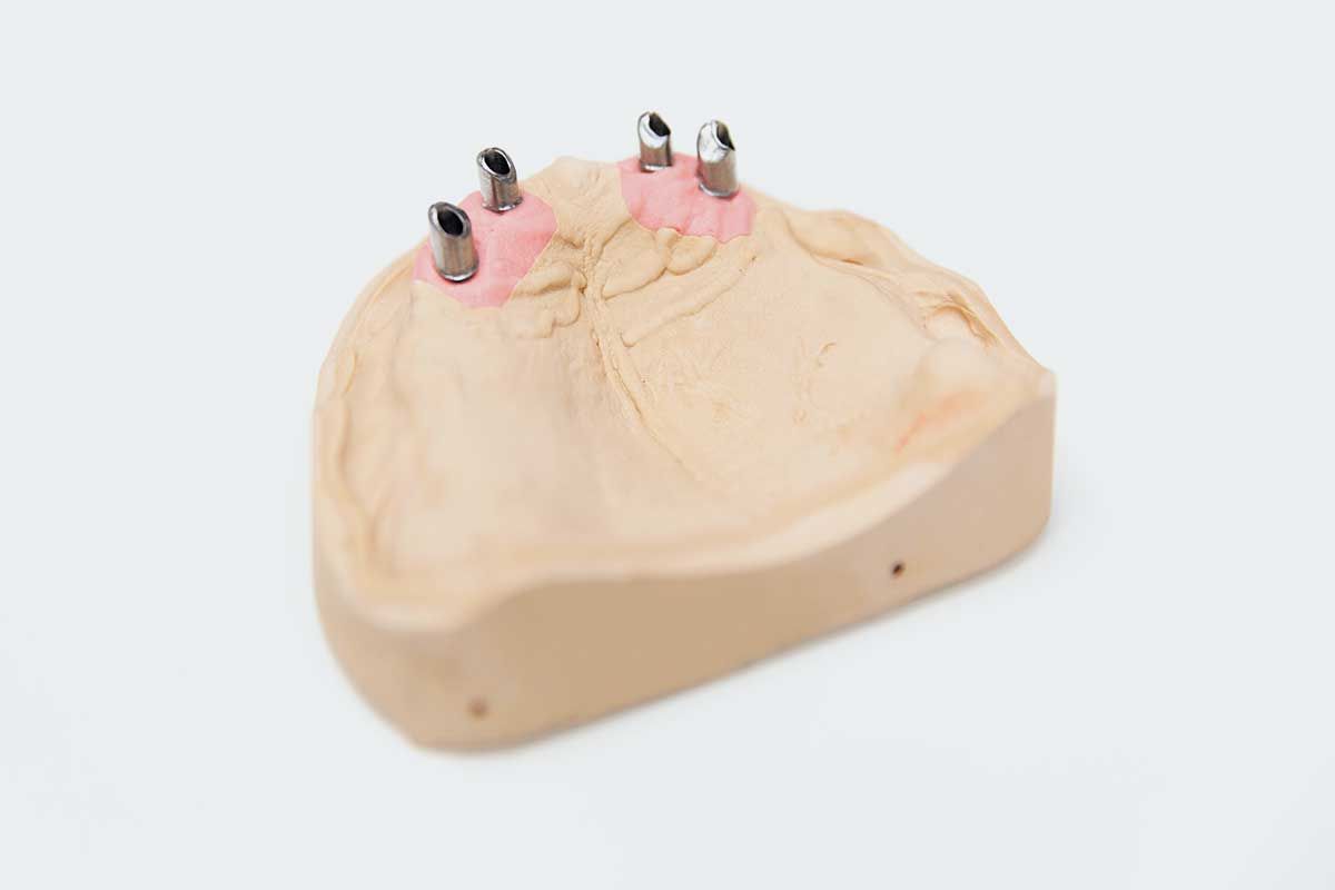 Implantat­systeme